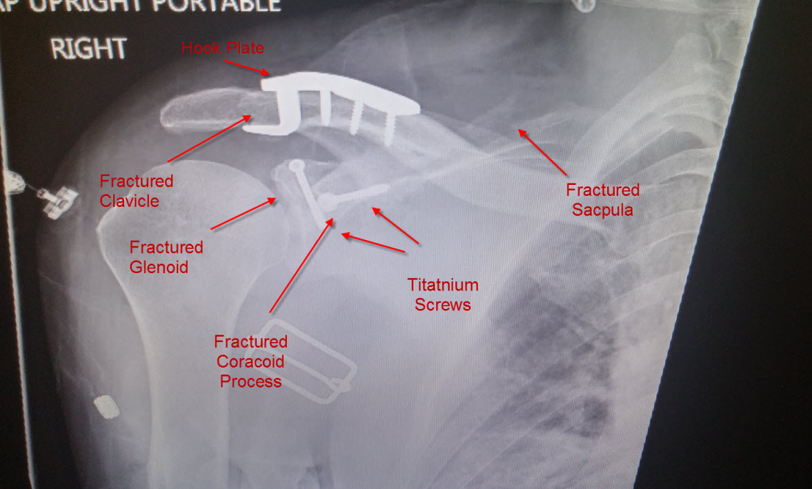 shoulder_fracture.jpg